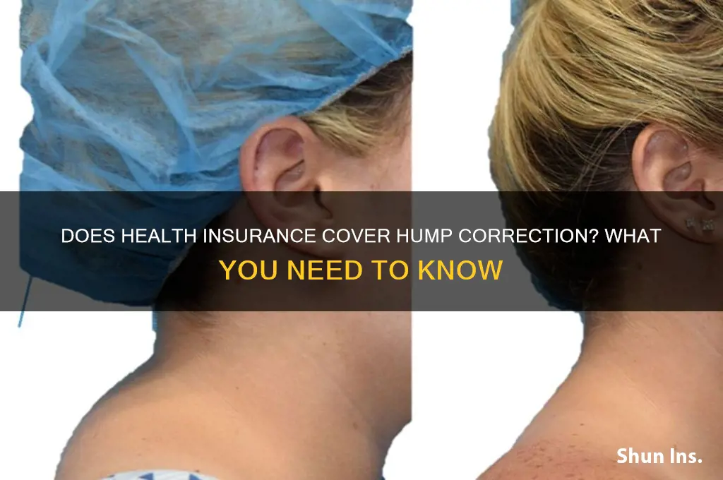 does health insurance cover hump correction