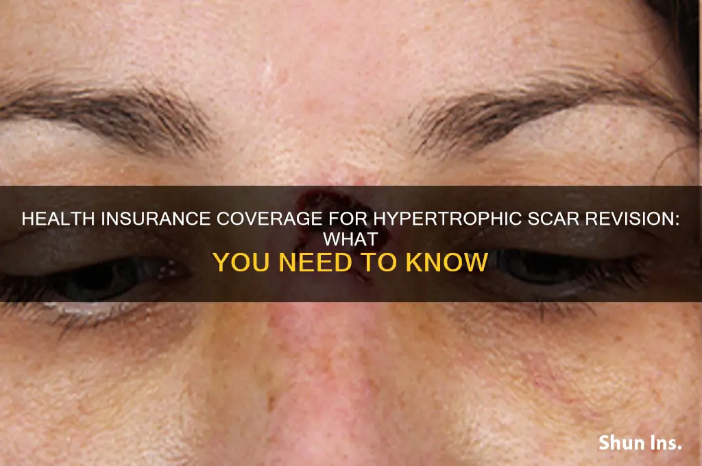 does health insurance cover hypertrophic scar revision