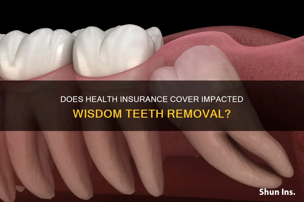 does health insurance cover impacted wisdom teeth