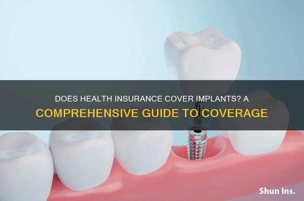 does health insurance cover implants