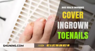 Does Health Insurance Cover Ingrown Toenail Treatment? What to Know
