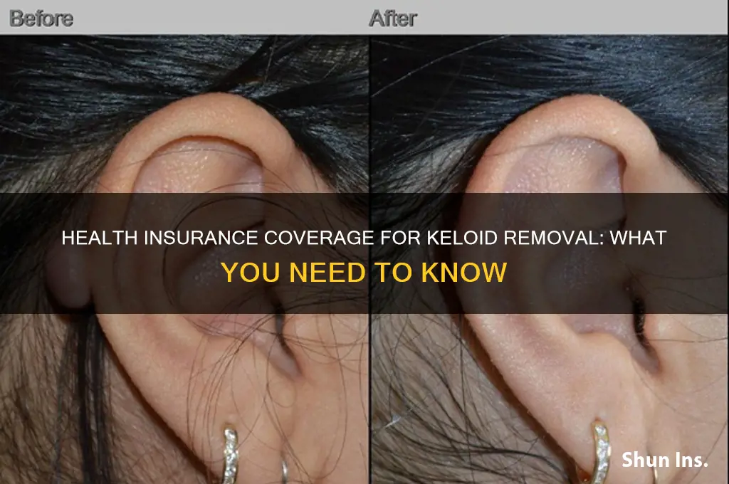 does health insurance cover keloid removal