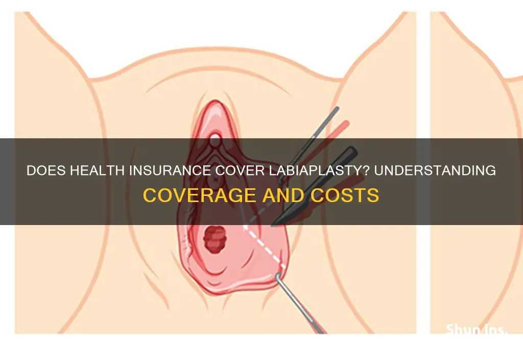 does health insurance cover labiaplasty