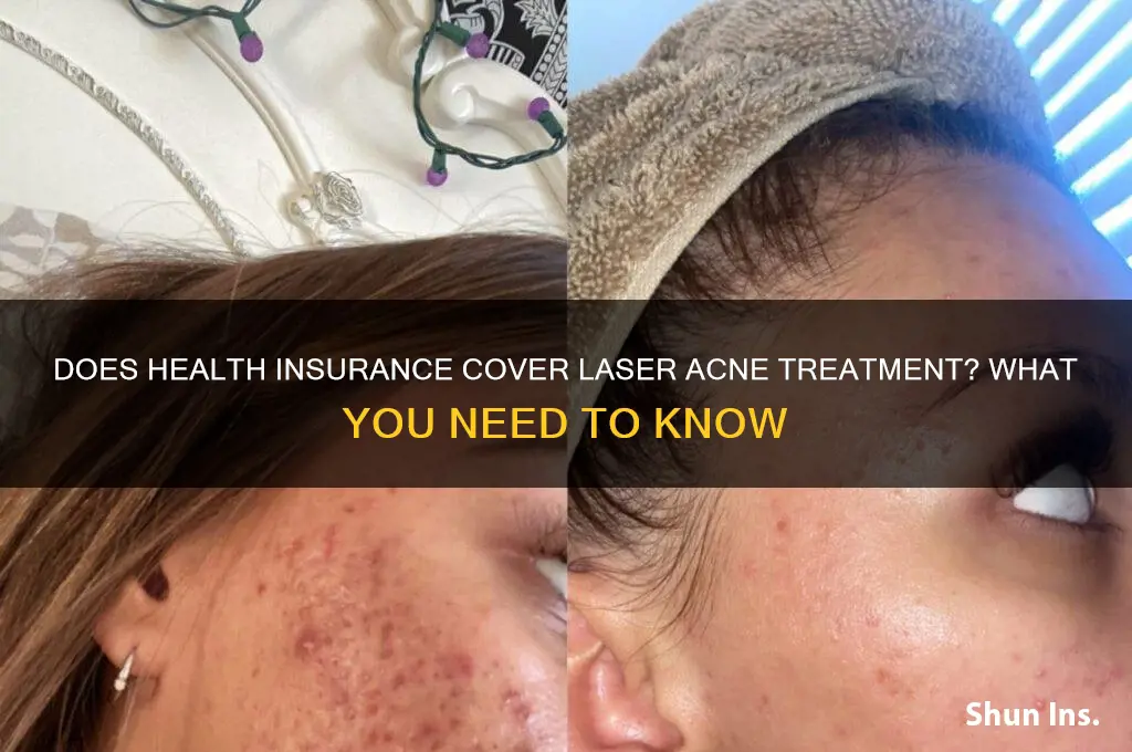 does health insurance cover laser acne treatment