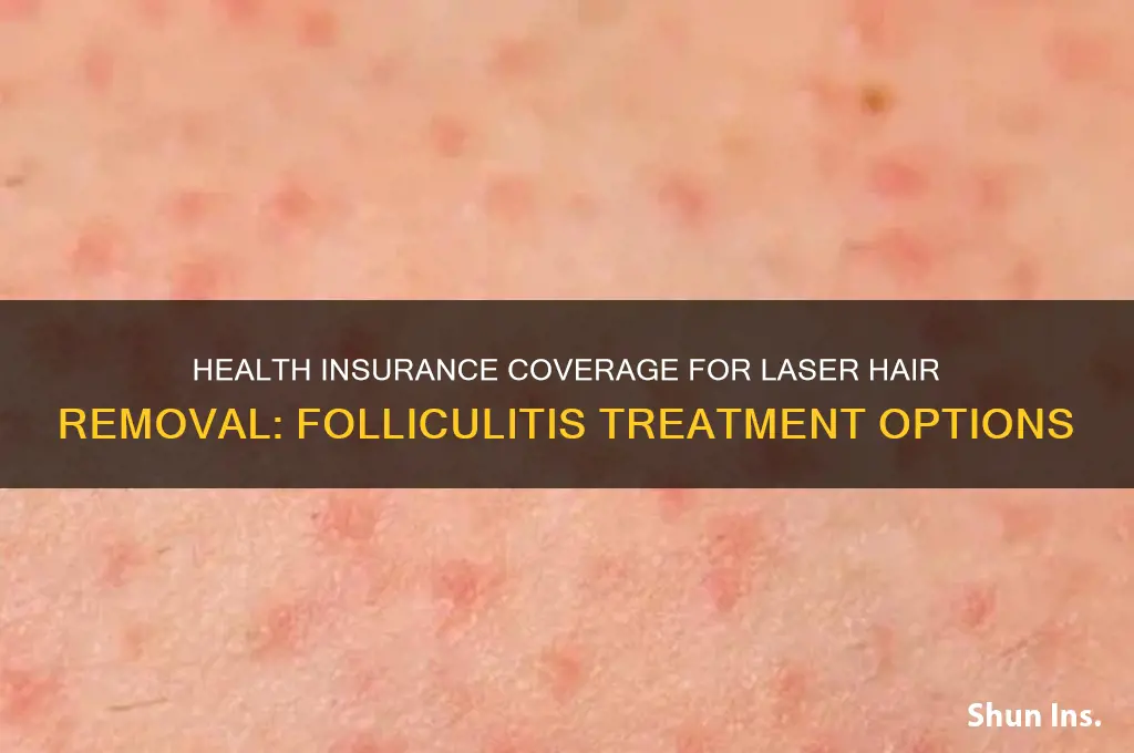 does health insurance cover laser hair removal for folliculitis