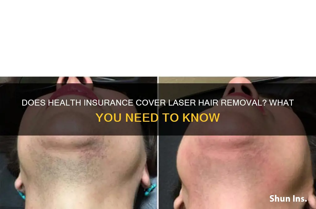 does health insurance cover laser hair removal