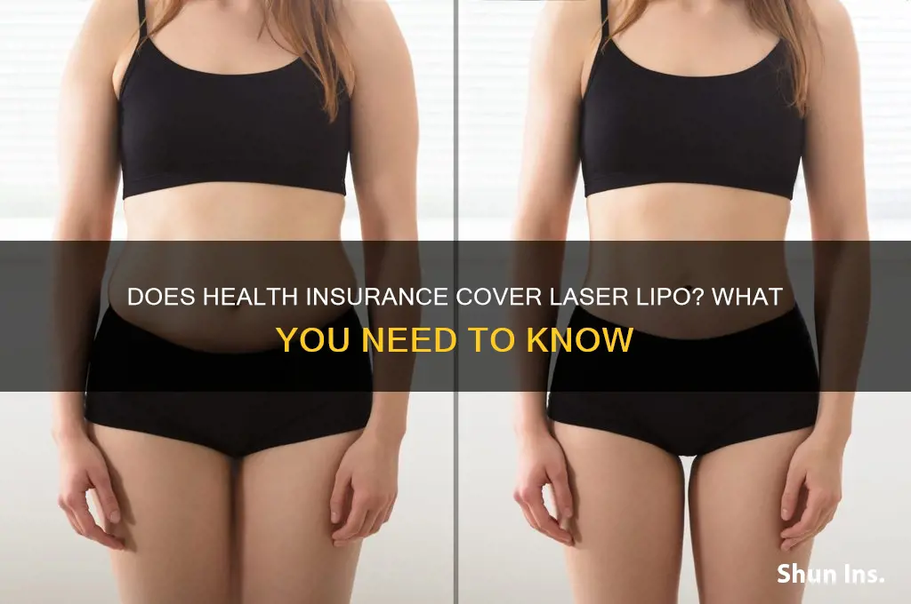 does health insurance cover laser lipo