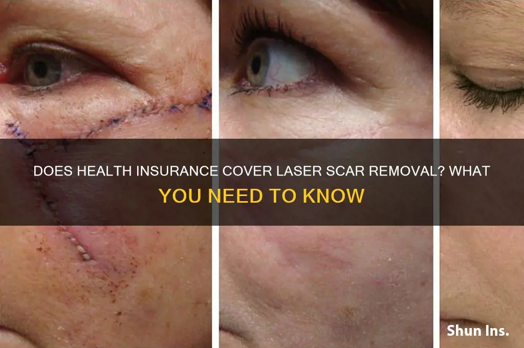 does health insurance cover laser scar removal