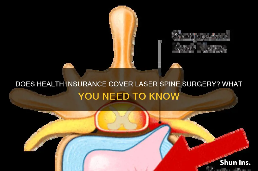 does health insurance cover laser spine surgery