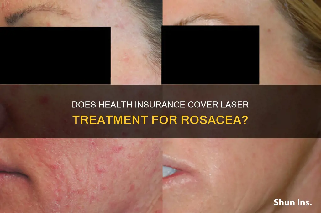 does health insurance cover laser treatment for rosacea