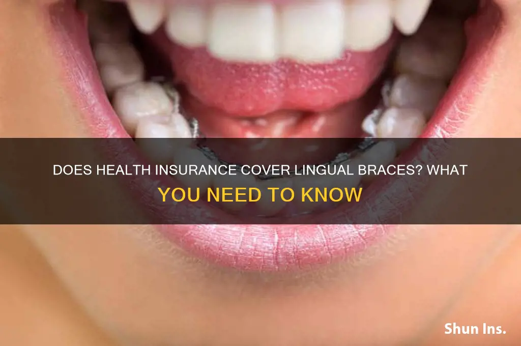 does health insurance cover lingual braces