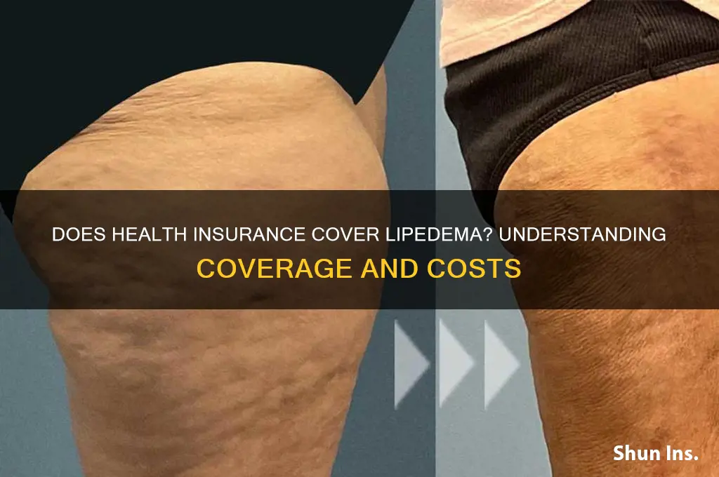 does health insurance cover lipedema
