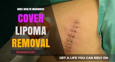 Is Lipoma Removal Covered by Health Insurance? What You Need to Know