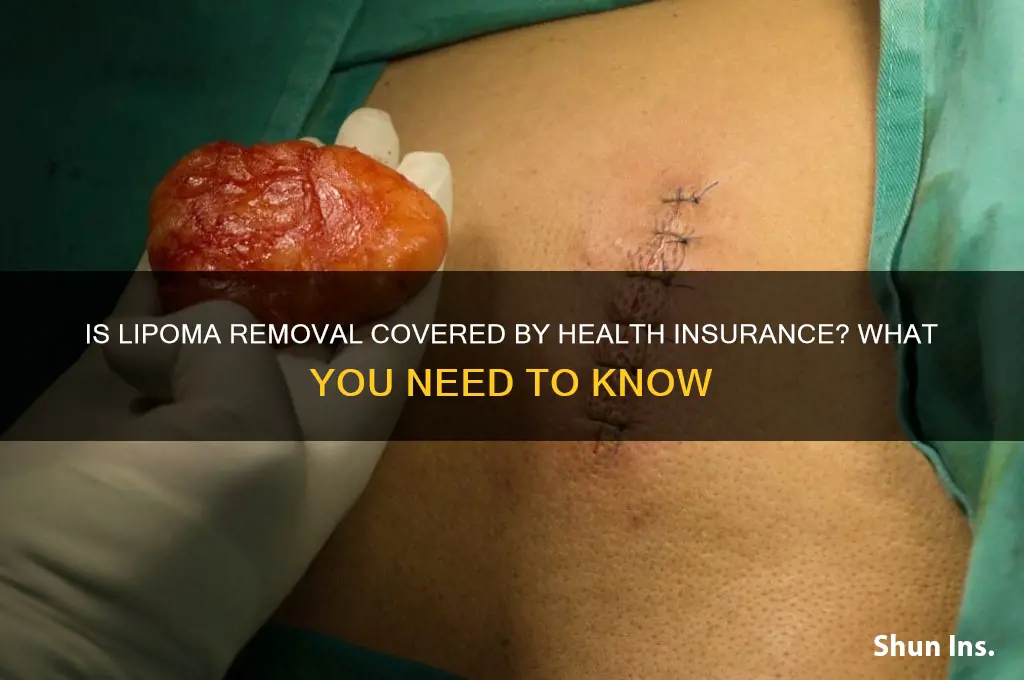 does health insurance cover lipoma removal