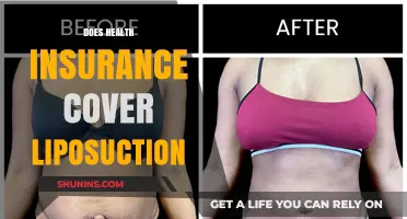 Does Health Insurance Cover Liposuction? Understanding Coverage and Costs