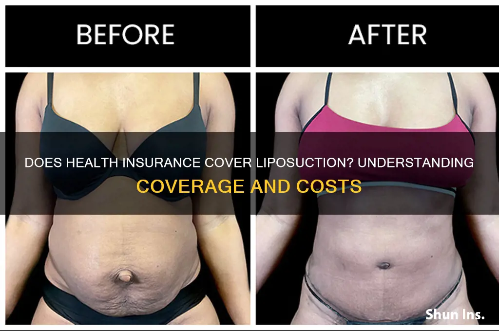 does health insurance cover liposuction