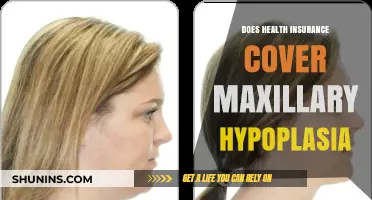 Does Health Insurance Cover Maxillary Hypoplasia? A Comprehensive Guide