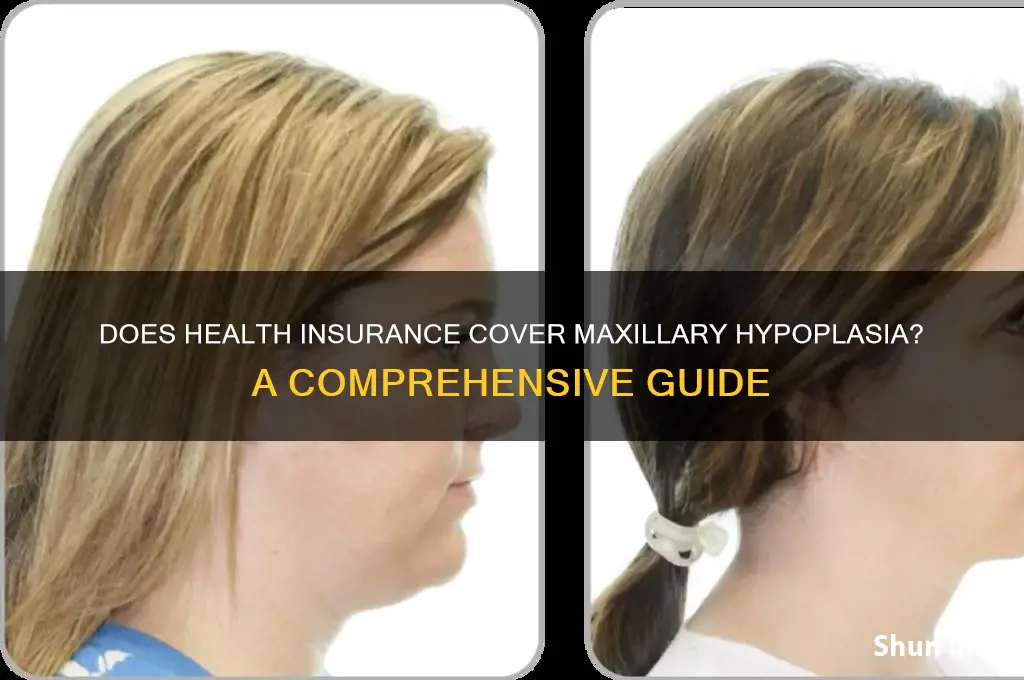 does health insurance cover maxillary hypoplasia