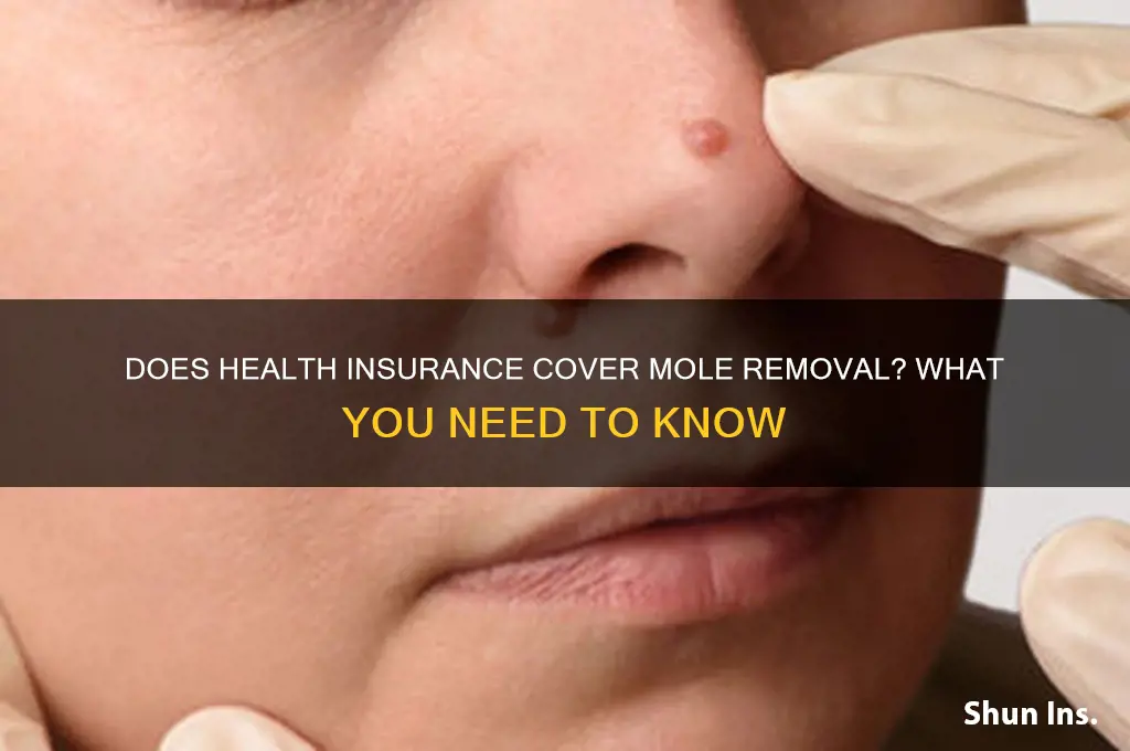 does health insurance cover mole removal