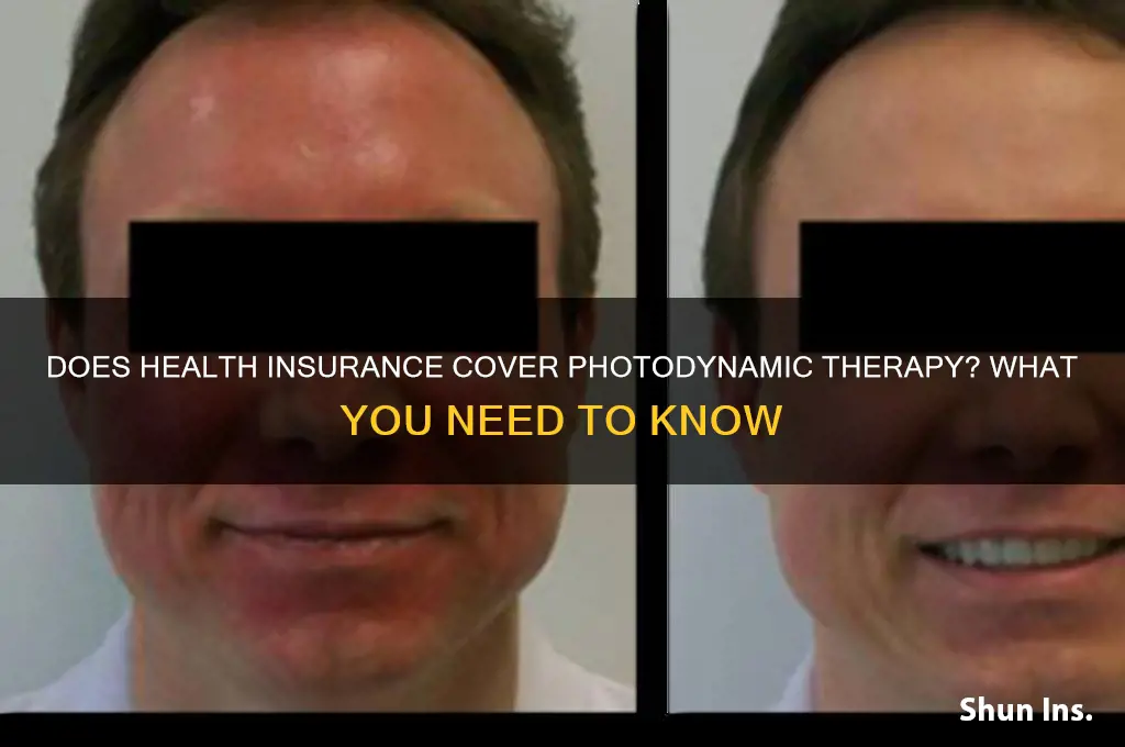 does health insurance cover photodynamic therapy