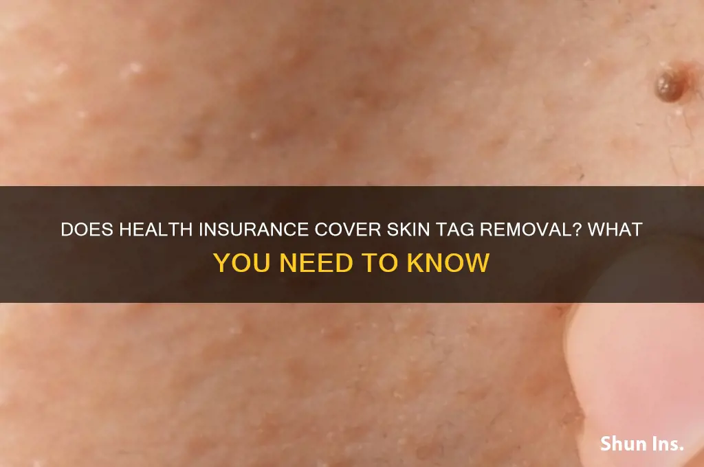 does health insurance cover removal of skin tags