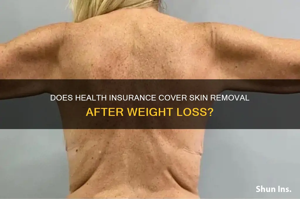 does health insurance cover skin removal after weight loss