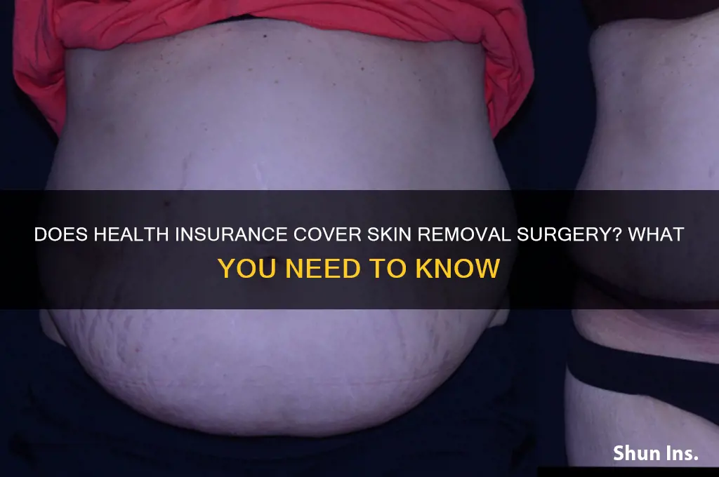 does health insurance cover skin removal surgery