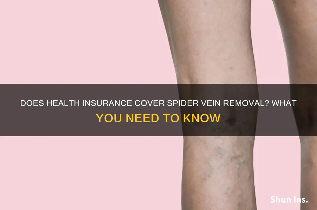 does health insurance cover spider vein removal