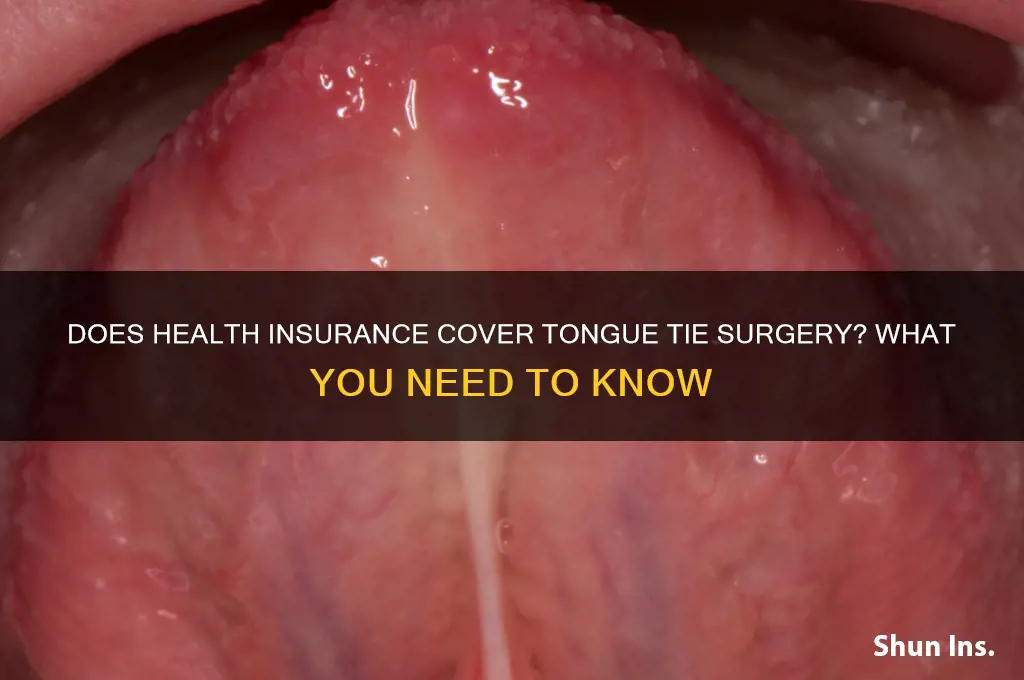 does health insurance cover tongue tie surgery