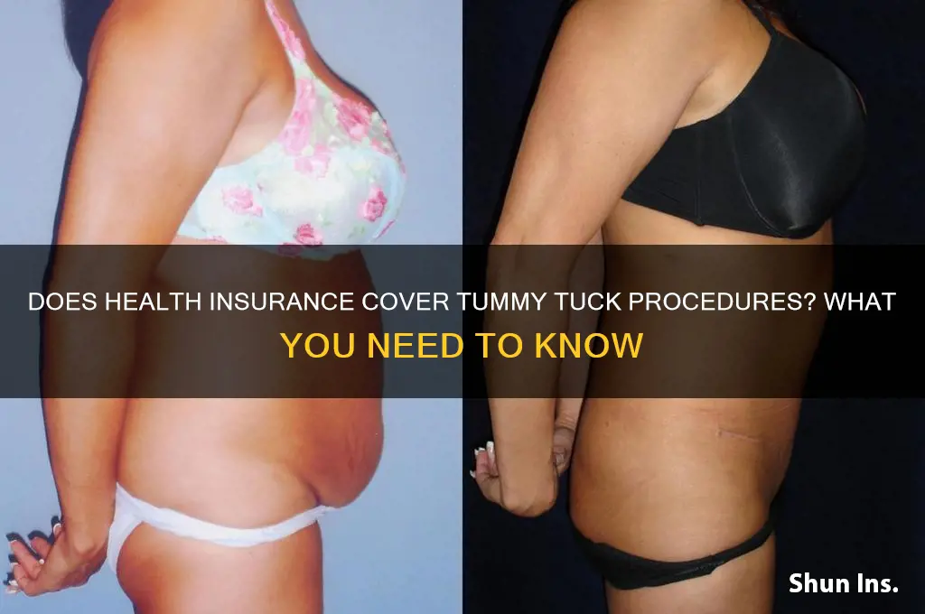 does health insurance cover tummy tuck