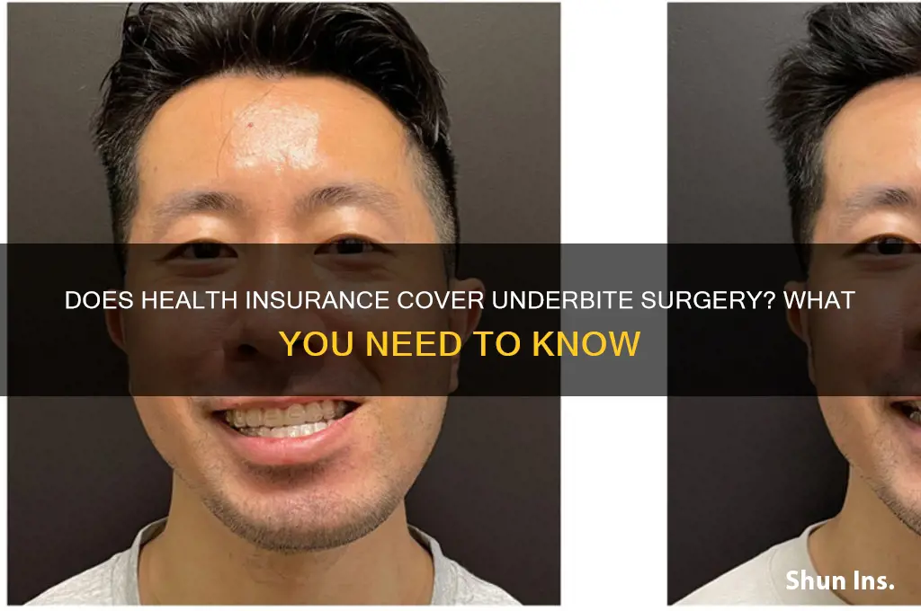 does health insurance cover underbite surgery