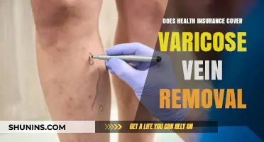 Does Health Insurance Cover Varicose Vein Removal? What You Need to Know