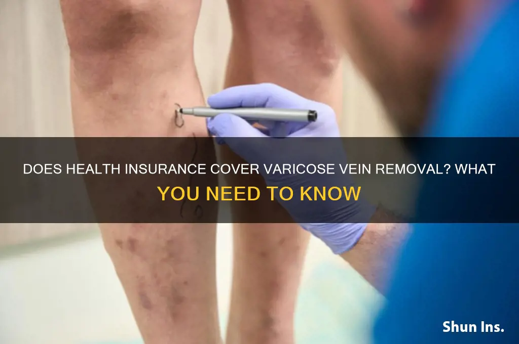 does health insurance cover varicose vein removal
