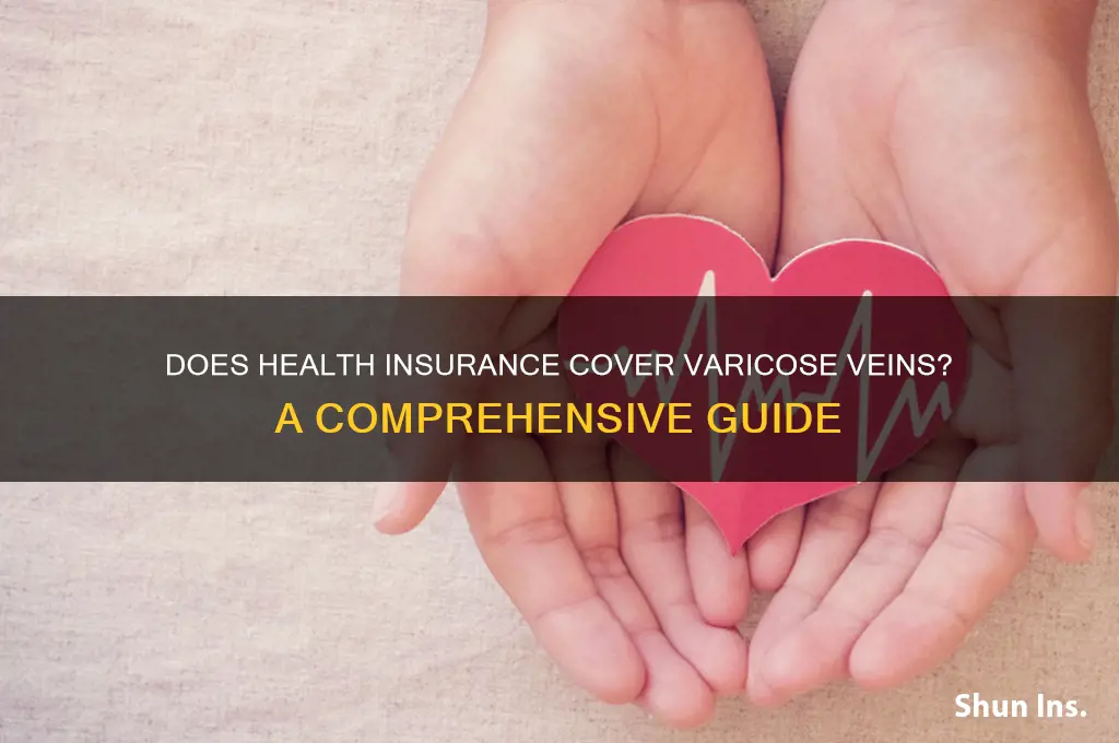 does health insurance cover varicose veins