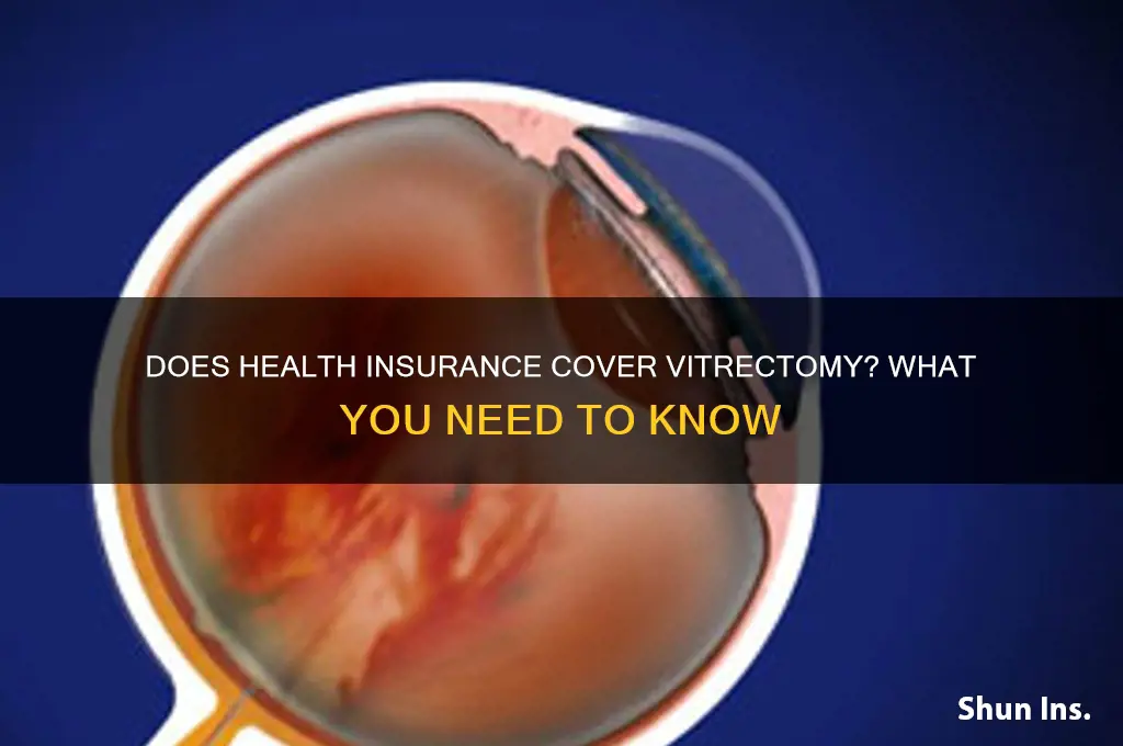 does health insurance cover vitrectomy