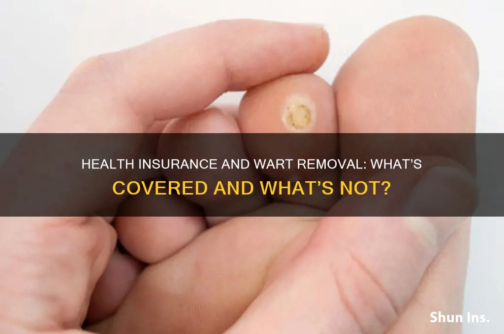 does health insurance cover wart removal