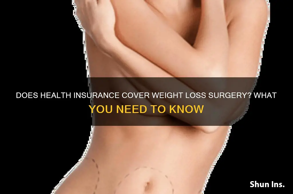 does health insurance cover weight loss surgery