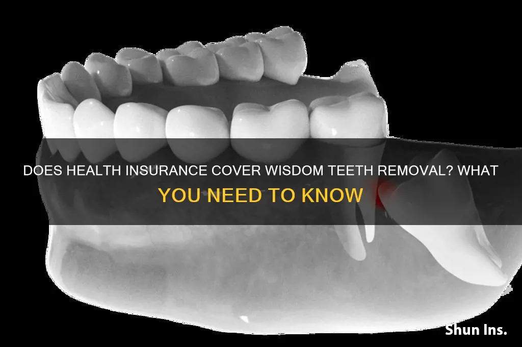 does health insurance cover wisdom teeth removal