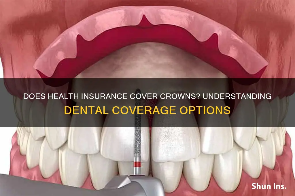 does health insurance covrr crowns