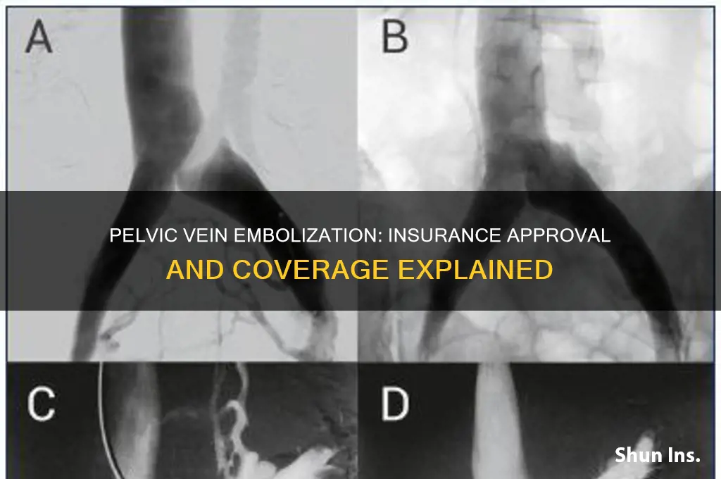 does insurance approves pelvic vein embolization