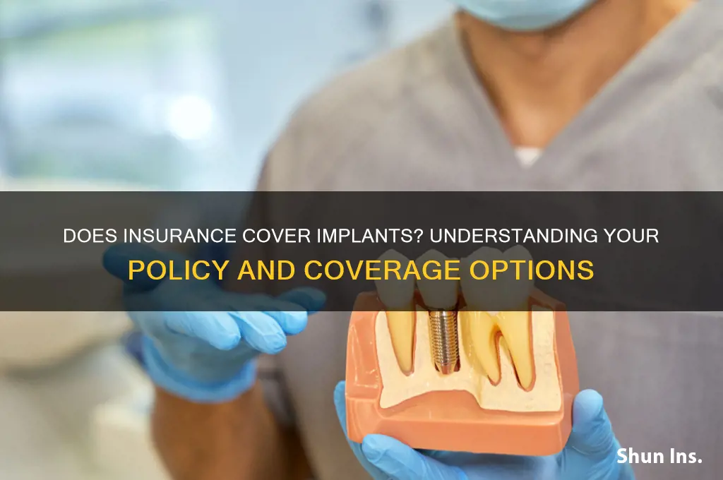 does insurance conver implants