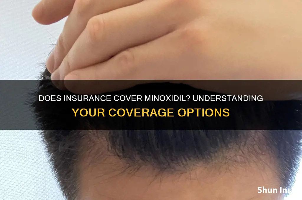 does insurance covet manoxidil