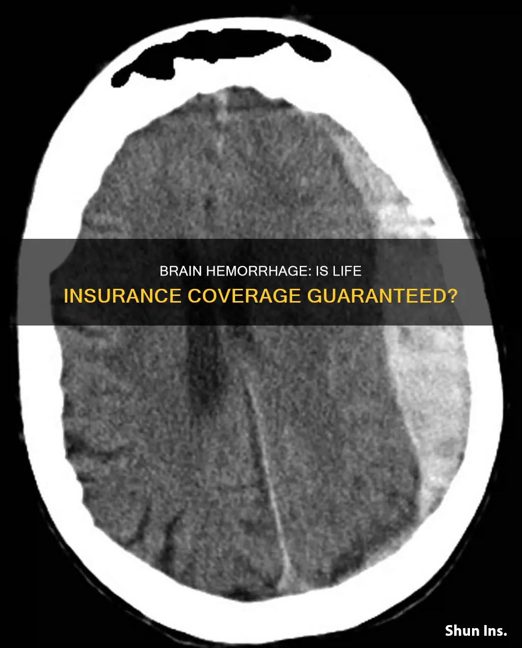 does life insurance cover brain hemorrhage