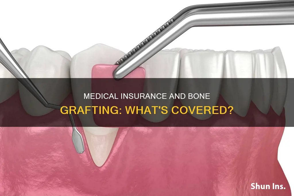 does medical insurance cover bone grafting