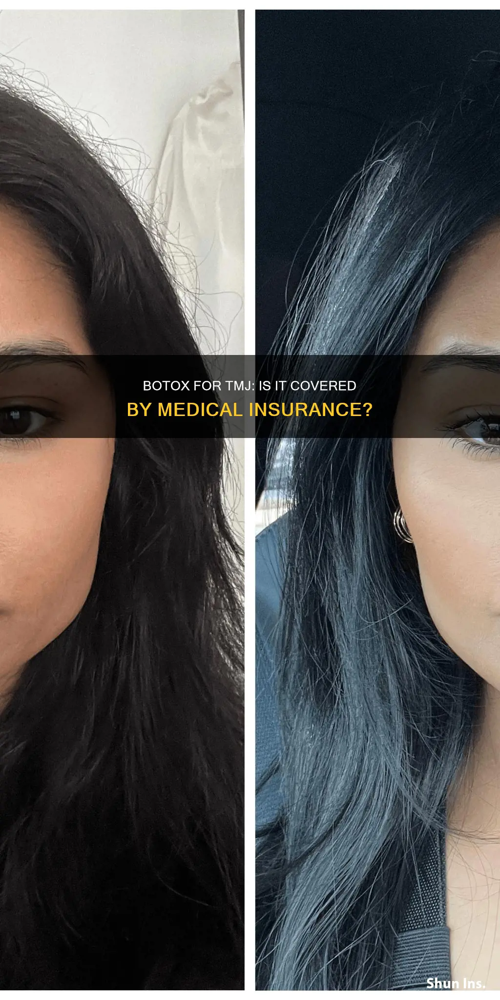 does medical insurance cover botox for tmj