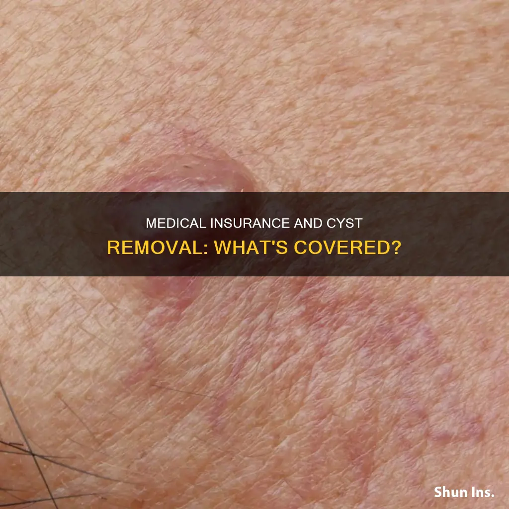 does medical insurance cover cyst removal