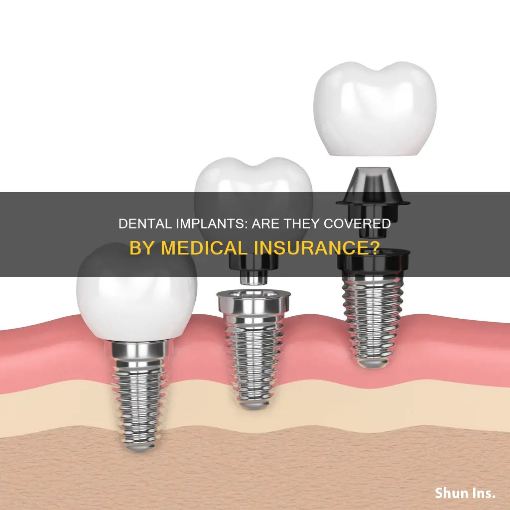 does medical insurance cover dental implants