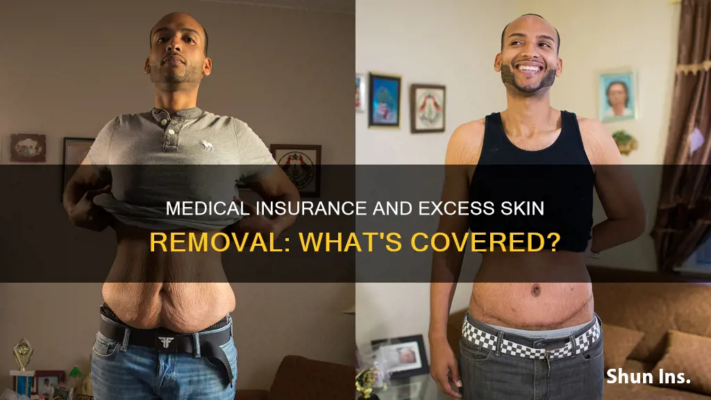 does medical insurance cover excess skin removal