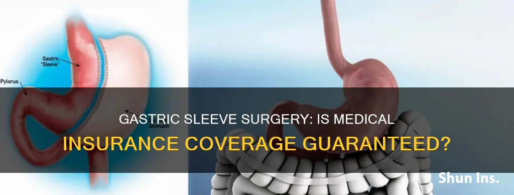 does medical insurance cover gastric sleeve