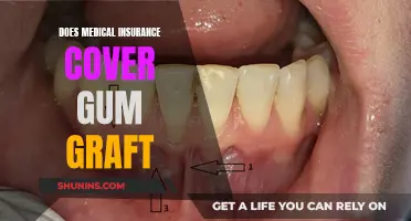 Gum Grafts: Are They Covered by Medical Insurance?